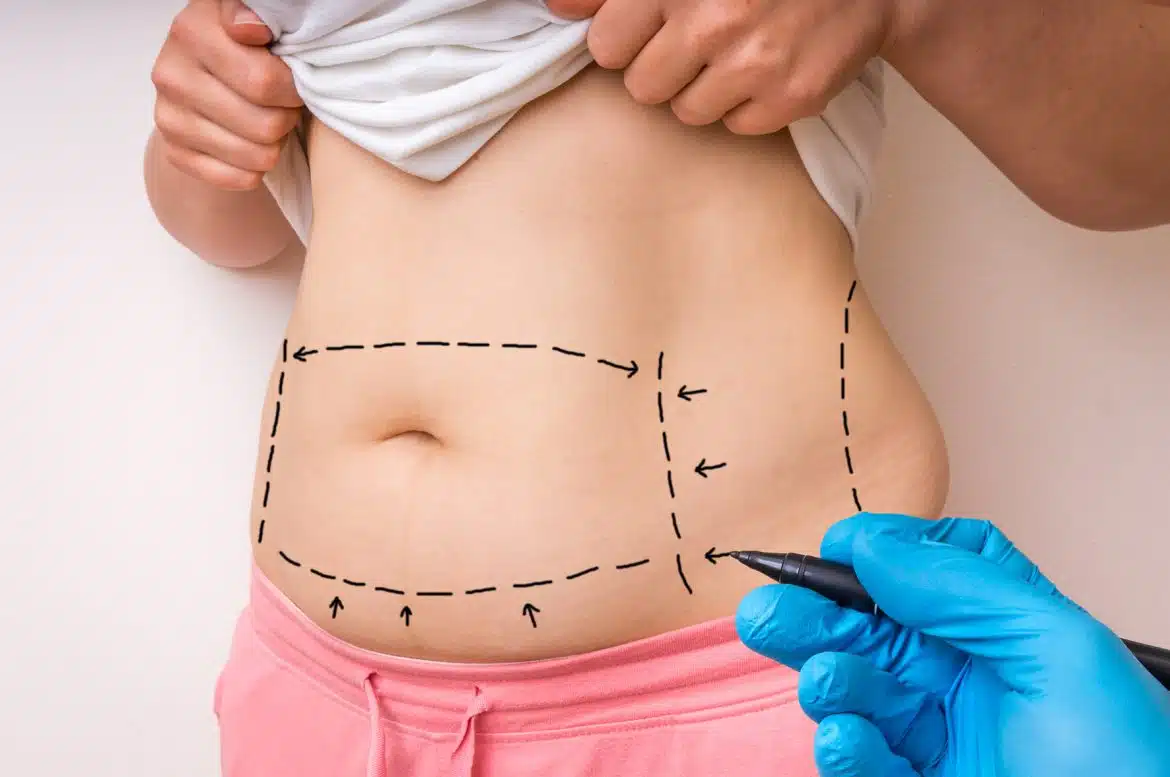 abdominoplastie