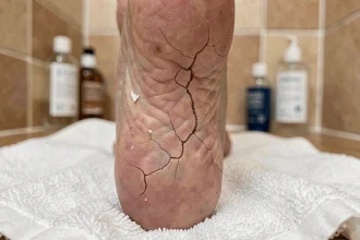 Gros plan sur le talon d'un pied féminin présentant une peau sèche et des fissures, posé sur une serviette blanche en salle de bain
