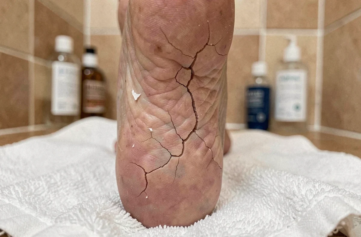 Gros plan sur le talon d'un pied féminin présentant une peau sèche et des fissures, posé sur une serviette blanche en salle de bain